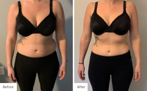 7 - Before and After of a woman's body using NeoraFit.