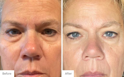 2 - Before and After Real Results photo of a woman's face.